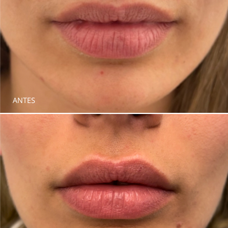 Aumento/ hidratación de labios
