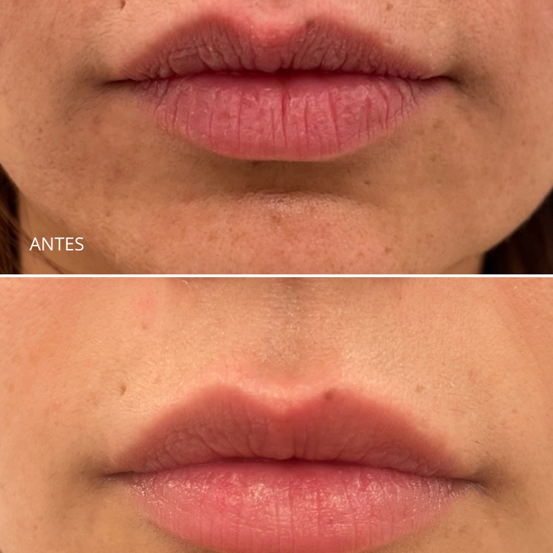 Aumento/ hidratación de labios