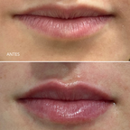 Aumento/ hidratación de labios