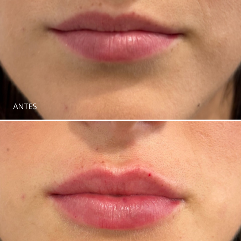 Aumento/ hidratación de labios