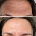 Tratamiento para el melasma. Dermamelan
