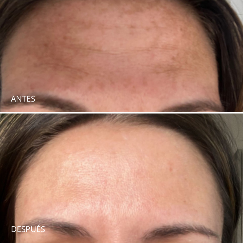 Tratamiento para el melasma. Dermamelan