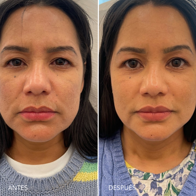 Armonización facial