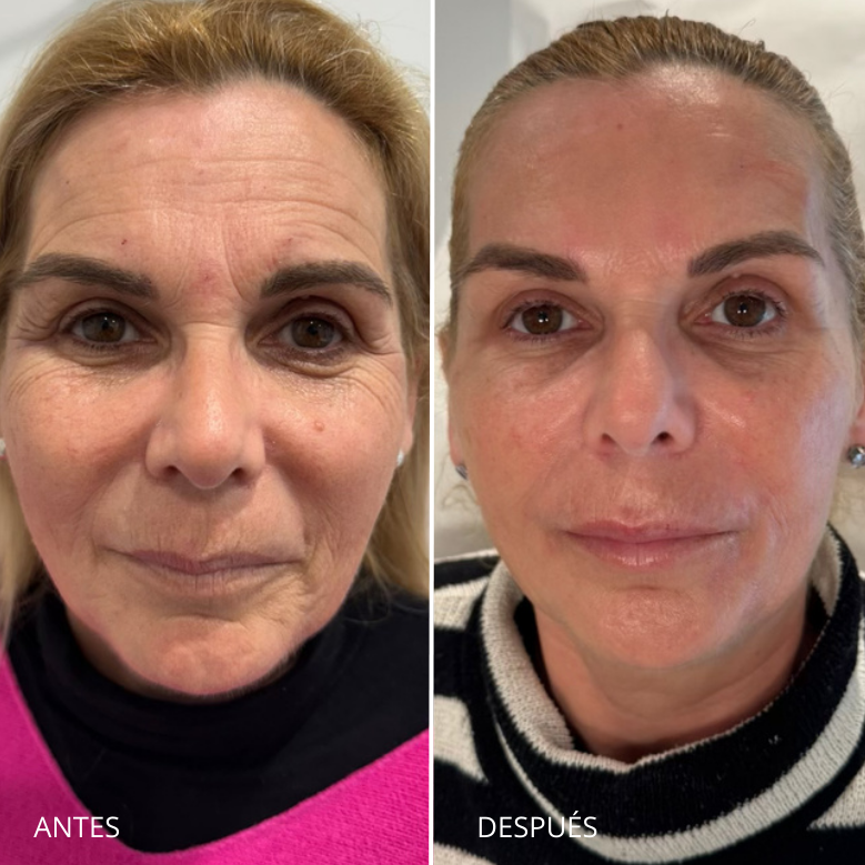 Armonización facial