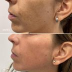Tratamiento para el melasma. Dermamelan