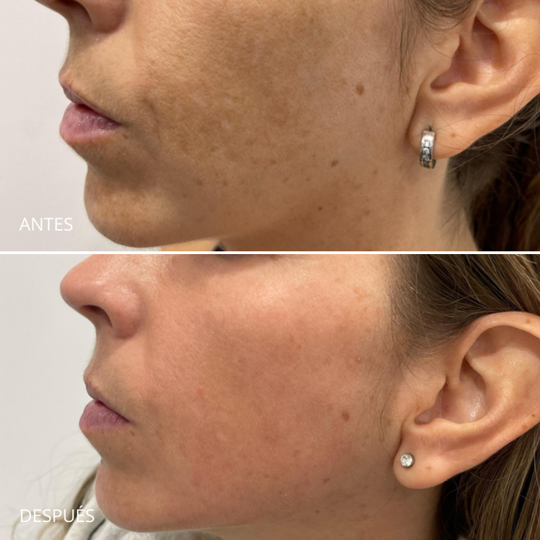 Tratamiento para el melasma. Dermamelan