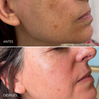 Tratamiento para el melasma. Dermamelan