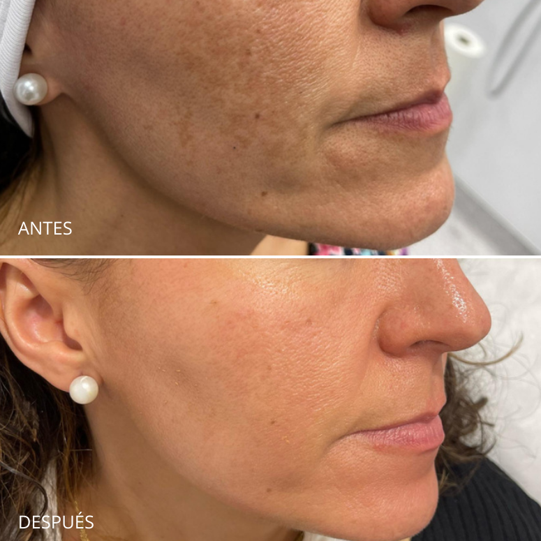 Tratamiento para el melasma. Dermamelan