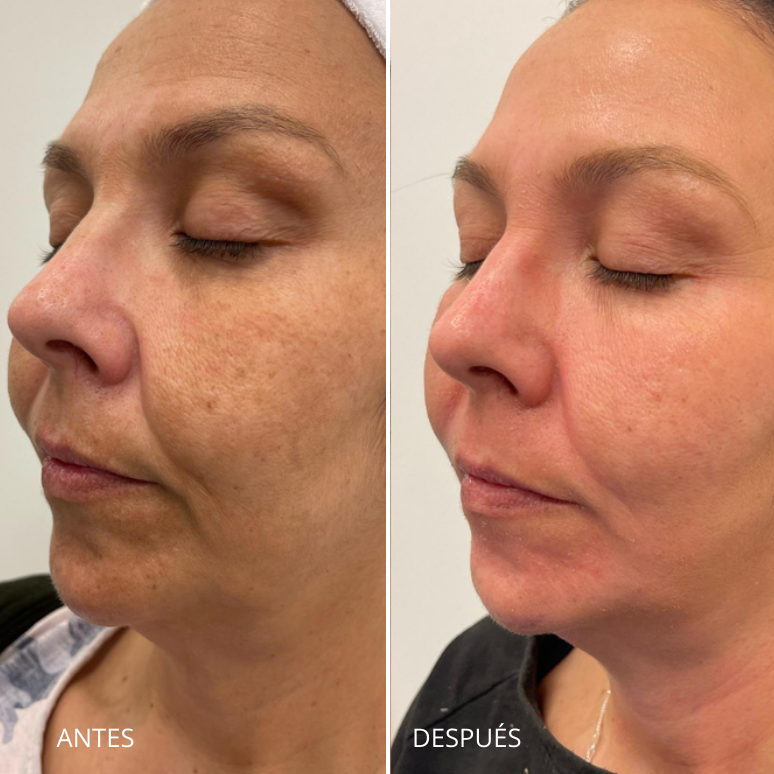 Tratamiento para el melasma. Dermamelan