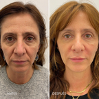 Armonización facial