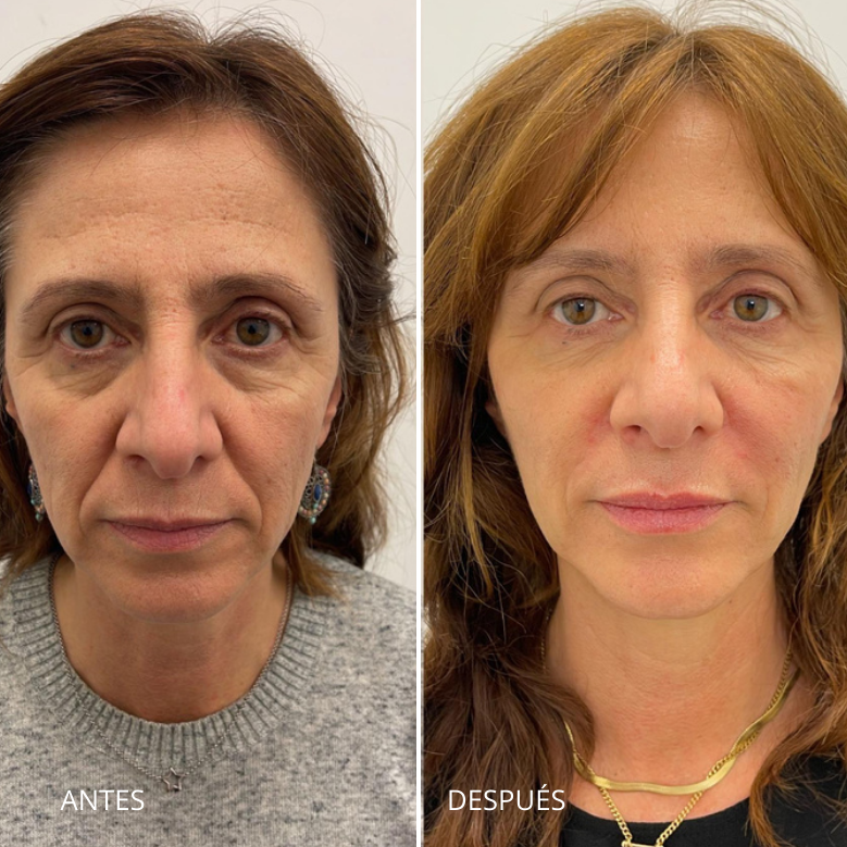 Armonización facial