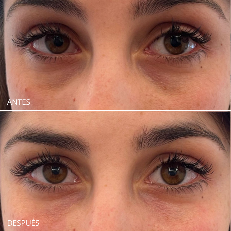 Relleno de ojeras