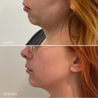 Lipolítico Facial
