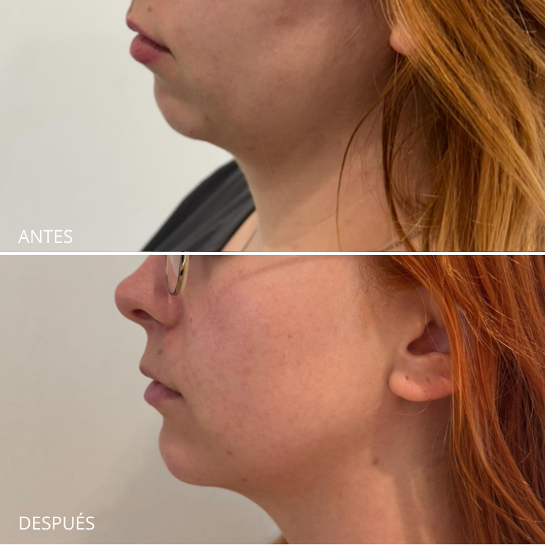 Lipolítico Facial