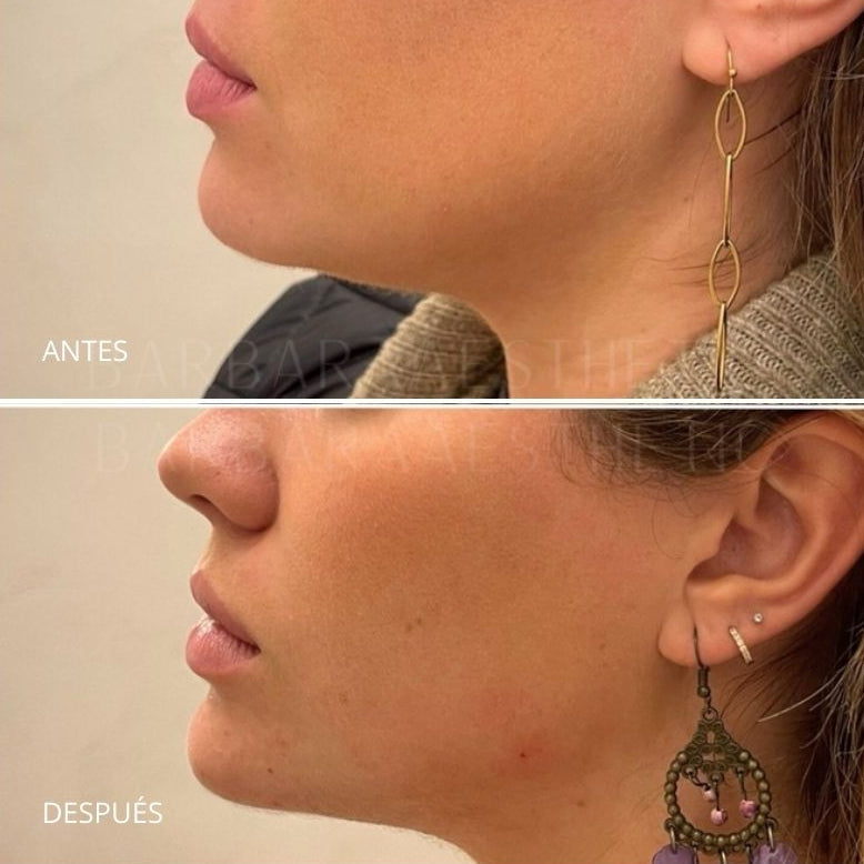 Lipolítico Facial