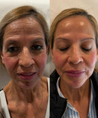 Armonización facial